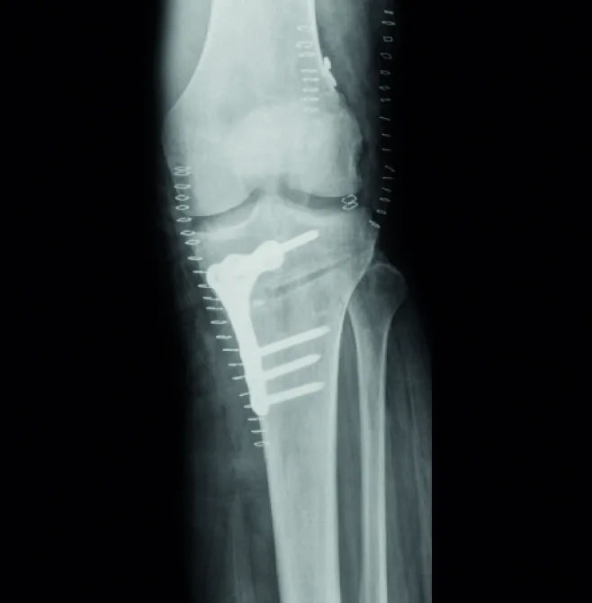 Postoperative xray 02